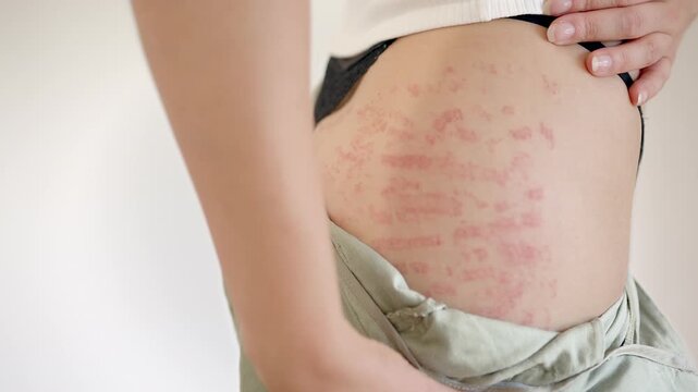 Woman Open Her Pants And Shows Her Thighs With Red Stretch Marks. - closeup shot