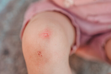Fototapeta premium Abrasions on the knees of Little child girl outdoor in summer