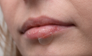 Obraz premium Cold sore patch, red pimple on woman's lips close up