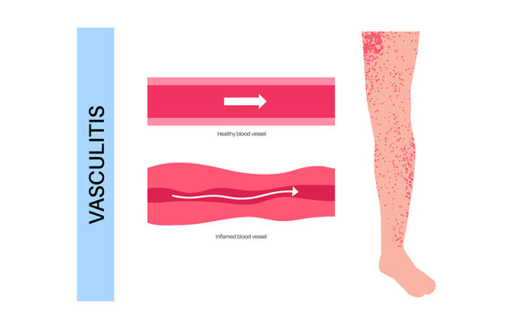 Vasculitis medical poster