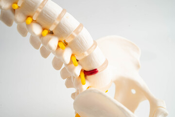 Spinal nerve and bone, Lumbar spine displaced herniated disc fragment, Model for treatment medical...