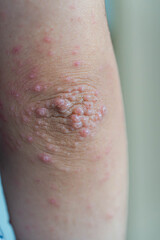 a close up of an elbow covered with hand, foot and mouth disease 