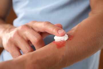 Man applying healing cream onto burned hand on brown background, closeup