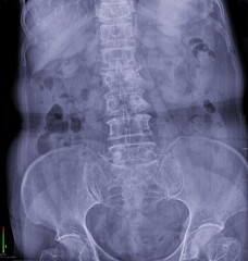 This image is an X-ray of the abdomen, which provides a view of the organs and structures within the abdominal cavity.