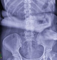 This image is an abdominal X-ray, also known as an abdominal film or KUB (Kidneys, Ureters, Bladder) X-ray when focused on those specific organs.
