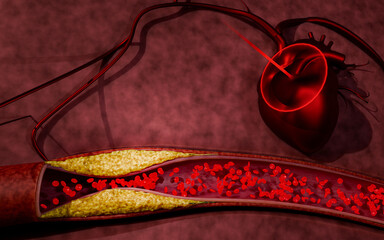 Blocked artery filled with accumulation of fat, cholesterol plaques, blood clots, unhealthy foods, and sugary beverages, illustrating risks of heart disease, stroke, and vascular damage. 3D rendering.