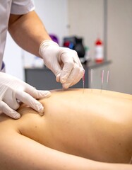 A person receiving acupuncture