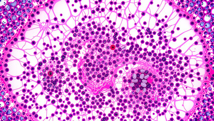 Microscopic cross-section of prostate tissue infected with acute bacterial infection. 