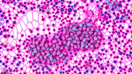 Microscopic cross-section of prostate tissue infected with acute bacterial infection. 