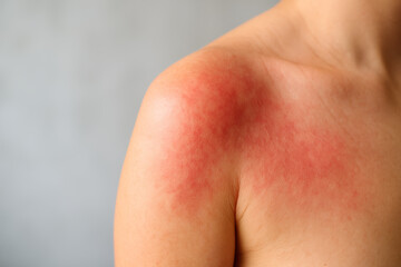 Close-up of male shoulder with skin redness allergy, inflammation or injury symptoms. Medical concept of irritation, dermatitis or pain with copy space.