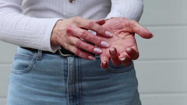 Skin care tips for managing eczema and psoriasis at home effectively without harsh treatments