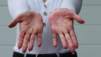 Effective strategies for managing eczema, psoriasis, and dermatitis on hands indoors