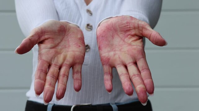 Effective strategies for managing eczema, psoriasis, and dermatitis on hands indoors