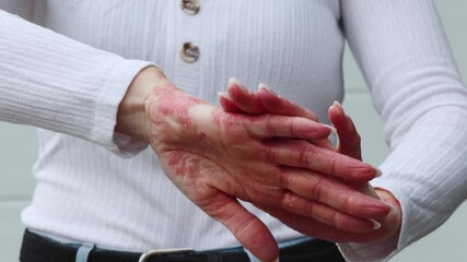 Tips for managing eczema and psoriasis symptoms on sensitive skin at home