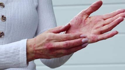 Understanding eczema, psoriasis, and dermatitis through effective skin care techniques in urban settings