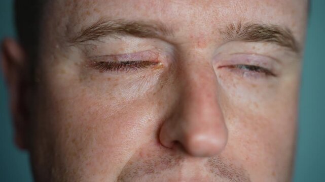 Close up of man with red irritated eye winking