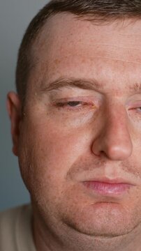 Close up of man with red eye checking for conjunctivitis