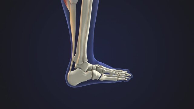 Inflammation of the Achilles Tendon in Foot