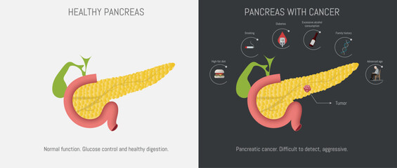 Healthy pancreas contrasting with pancreas with cancer