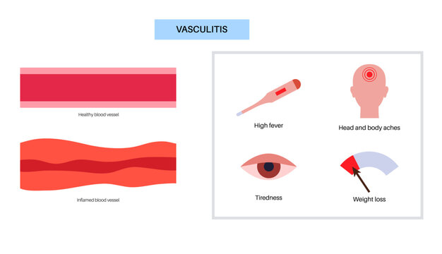 Vasculitis medical poster