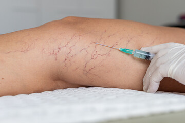A close-up of a hand in a white glove administering an injection into a leg with visible varicose veins. The scene focuses on medical treatment for vein issues.
