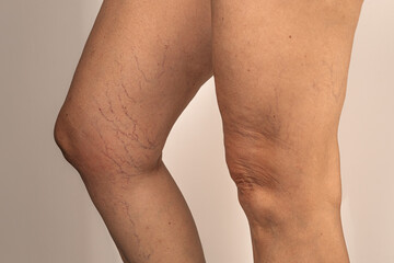 Close-up of a human leg showing varicose veins and visible capillaries. The skin appears slightly wrinkled and discolored around the knee area.