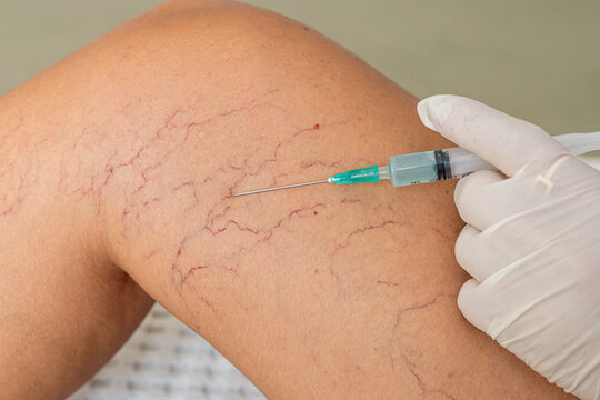 A close-up of a leg with visible varicose veins and capillaries. A gloved hand holds a syringe, preparing for a medical procedure.