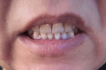 A close-up of a person's mouth showing their teeth, with some showing minor staining, highlighting oral hygiene practices. © Starmarpro