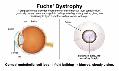 Fuchs' Dystrophy Eye Flashcard Illustration