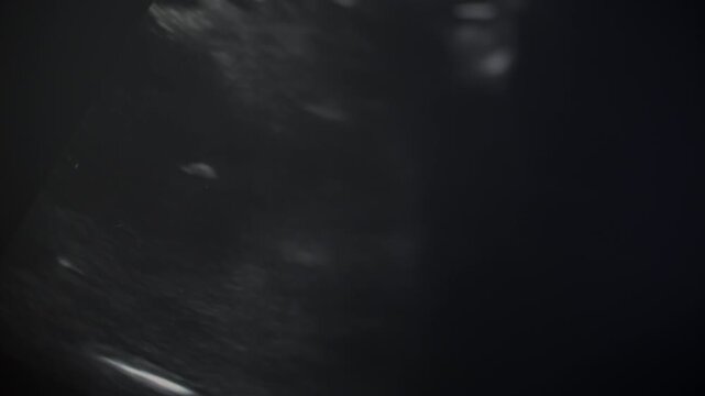 Ultrasound scan image on monitor screen