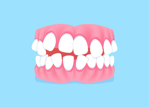 Full mouth teeth - Crooked illustration vector design. Dental care concept.