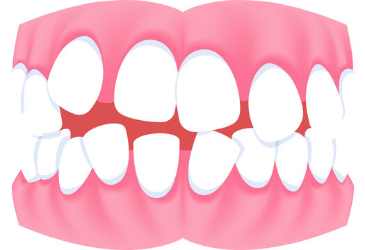 Full mouth teeth - Crooked illustration transparent design. Dental care concept.