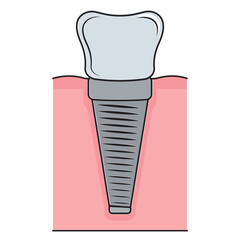 Dental implant. Screw prosthesis, Illustration of dental implantation,orthodontic dental implantation