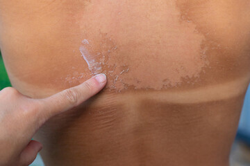 The back is sunburned and peeling. Selective focus.