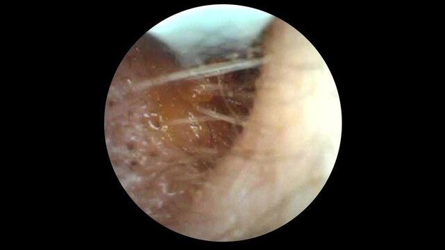 Medical endoscopic view inside a patient&rsquo;s ear showing a doctor removing a chunk of earwax with a tool, illustrating healthcare, hygiene, and ear cleaning procedures. 14839	