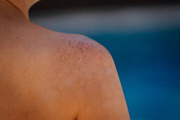 Close-up of a sunburned shoulder showing red, irritated skin and sun damage, with a blurred pool...