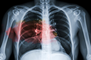 Medical X-ray reveals lung inflammation, offering insight into respiratory health and disease diagnosis for educational and healthcare purposes regarding pulmonary illness