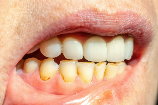 Dental calculus on teeth. Bacterial plaque on smokers teeth