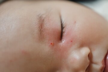虫刺されで左目周りが赤くなり、一部が出血した赤ちゃんの顔。