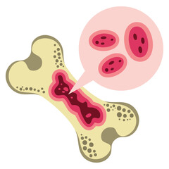 Bone cancer sarcoma awareness survivor ribbon icon vector illustration isolated design health symbol medical support and awareness concept for visuals