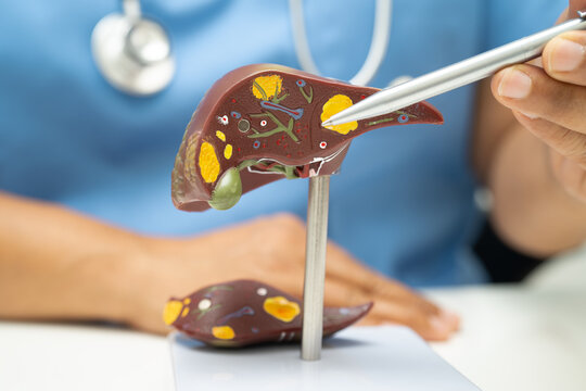 Cirrhosis, Liver cancer, fatty liver, Asian doctor with liver human anatomy model in World Hepatitis Day at hospital.