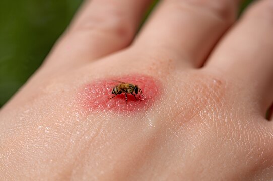 Bee sting on swollen hand with redness visible on skin  
