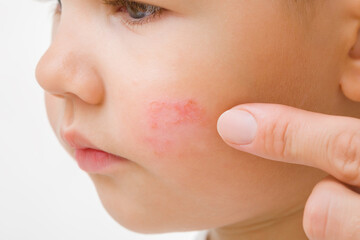 Obraz premium Young adult mother hand finger pointing to red rash on toddler boy cheek isolated on light gray background. Baby allergy from food. Skin problem. Closeup. Side view.