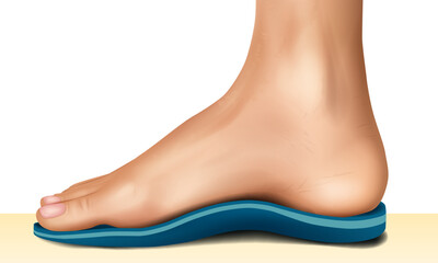 Realistic medical illustration of a human foot with an orthopedic insole, showing arch support and correction for flat feet. Anatomical side view of foot wearing orthopedic sole