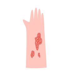 zoster virus infection disease concept