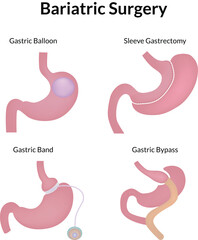 Bariatric Surgery Procedures Gastric Balloon Sleeve Band and Bypass Vector Illustration