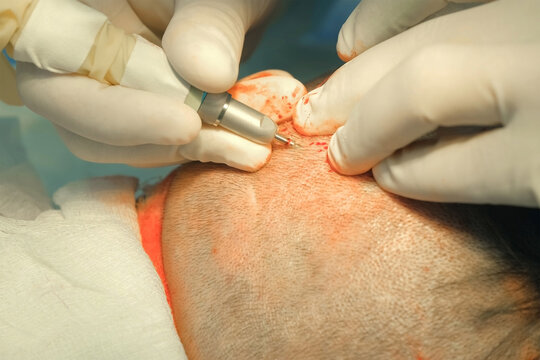Surgeon cuts out hair grafts from patient head nape using punch to hair transplant. Problem of baldness of men in middle age, treatment of alopecia by hair transplantation surgery in clinic hospital.