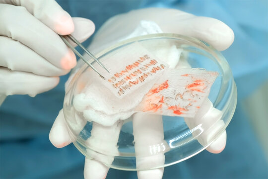 Surgeon nurse hands putting changing hair grafts using tweezers preparing it to hair transplantation in clinic. Problem of baldness, treatment of alopecia by hair transplant surgery in hospital.