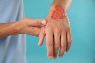 Man with burned hand on light blue background, closeup