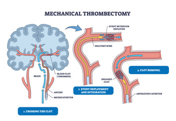 Mechanical thrombectomy diagram shows brain, artery, and stent illustrating clot crossing, stent deployment, and clot removal steps. Outline diagram